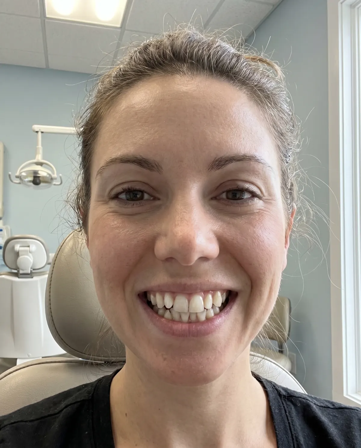 Aligners — Before